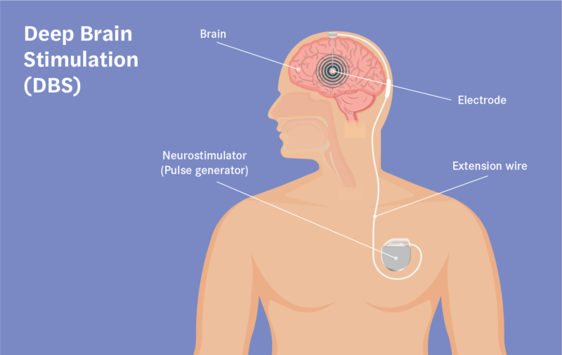 Text reads: deep brain stimulation (DBS). To the right is an illustration of a person from the abdomen up. The brain is shown with an electrode implanted in the brain. From the implant a wire extends to a neurostimulator (pulse generator) that is shown on top of the chest.