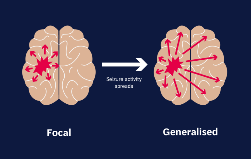 epilepsy brain diagram