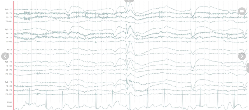 How brain activity appears as an EEG trace