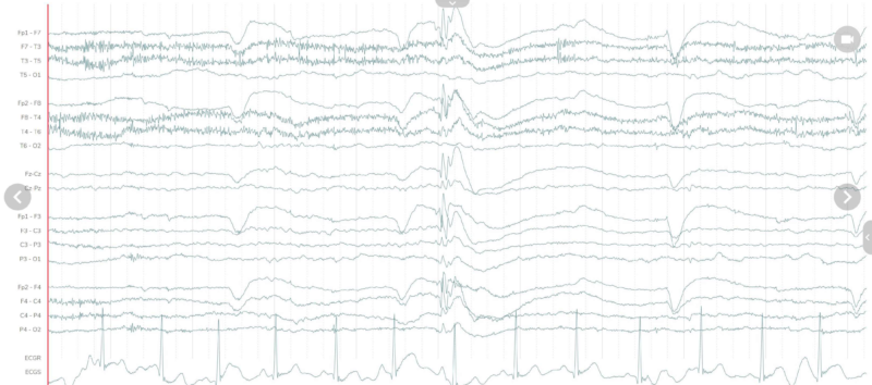 normal versus abnormal eeg