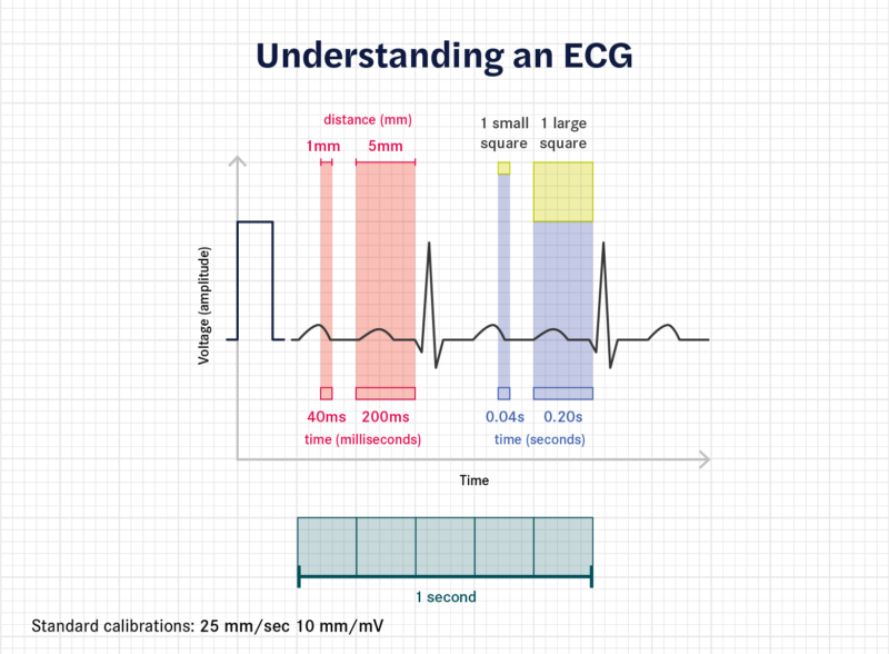 An illustration demonstrating how to read a electrocardiogram trace.