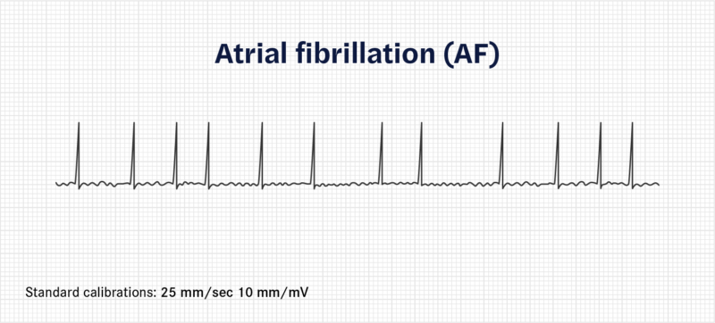 A trace demonstrating atrial fibrullation