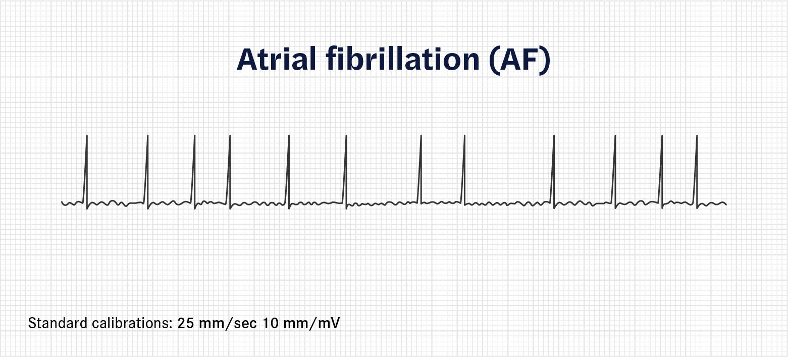 How to calculate heart rate from ECG (or EKG) - Seer Medical