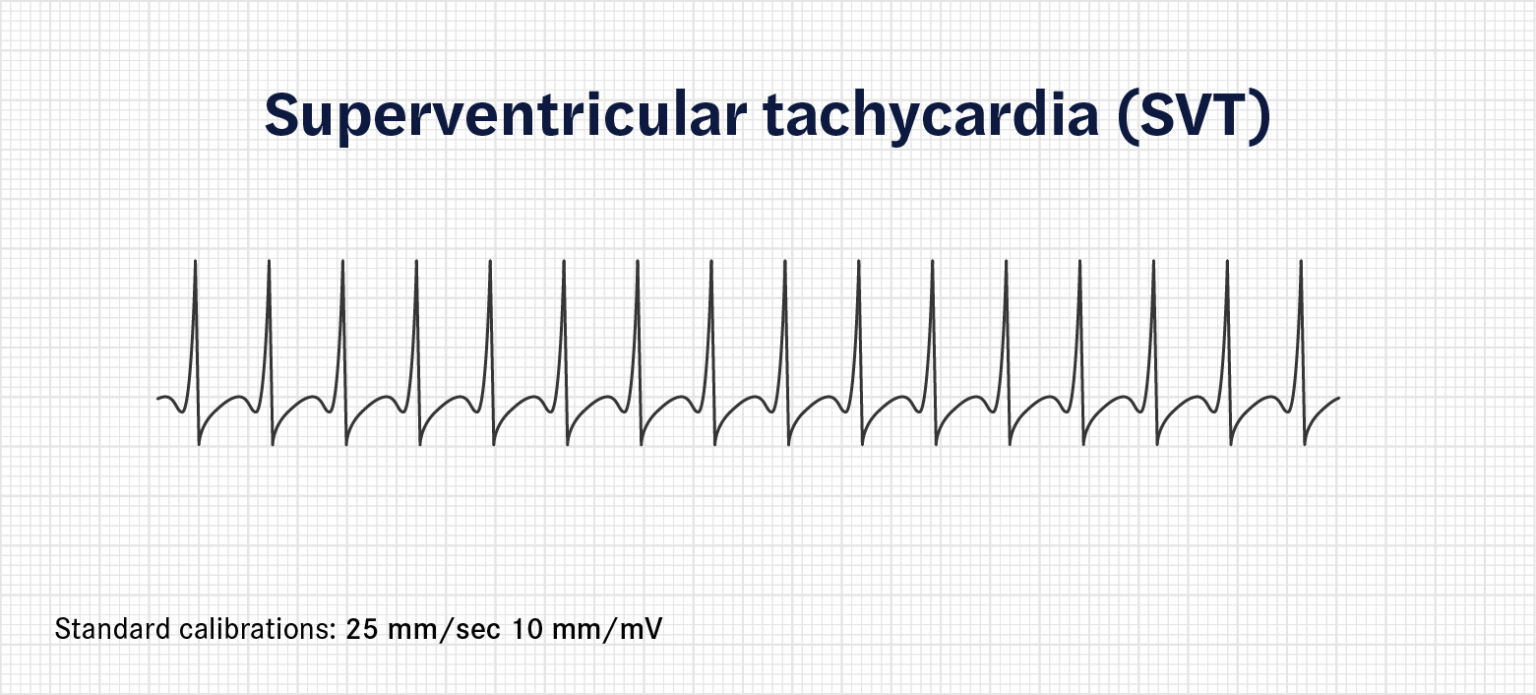 How To Calculate Heart Rate From Ecg (or Ekg) - Seer Medical