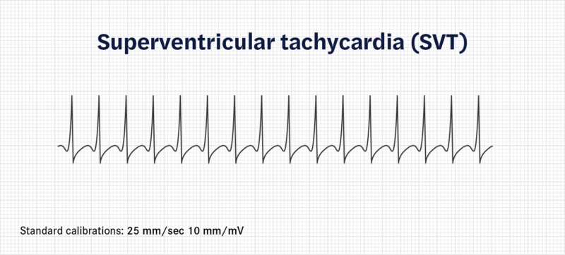 A trace demonstrating superventricular tachycardia