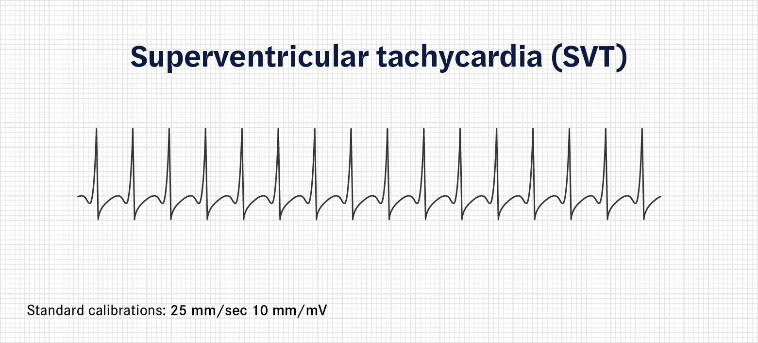 How to calculate heart rate from ECG (or EKG) - Seer Medical