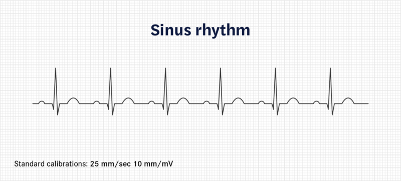 Trace of a normal sinus rhythm
