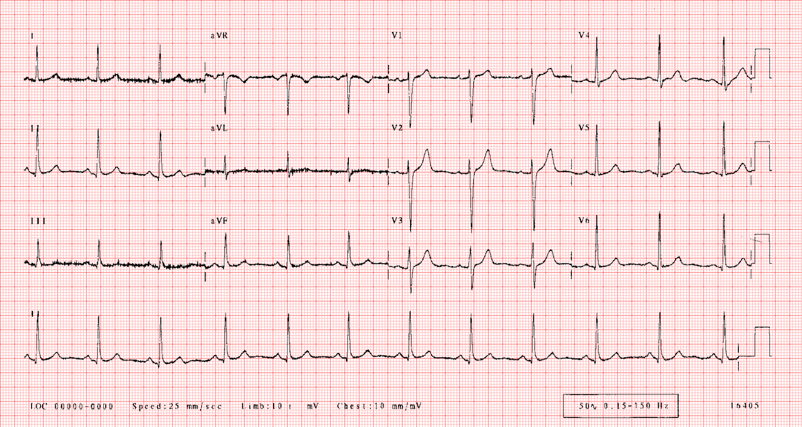 ultimate-guide-to-the-ecg-test-seer-medical