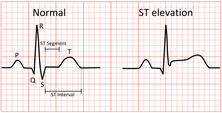 An illustration demonstrating how ST elevation appears on a trace