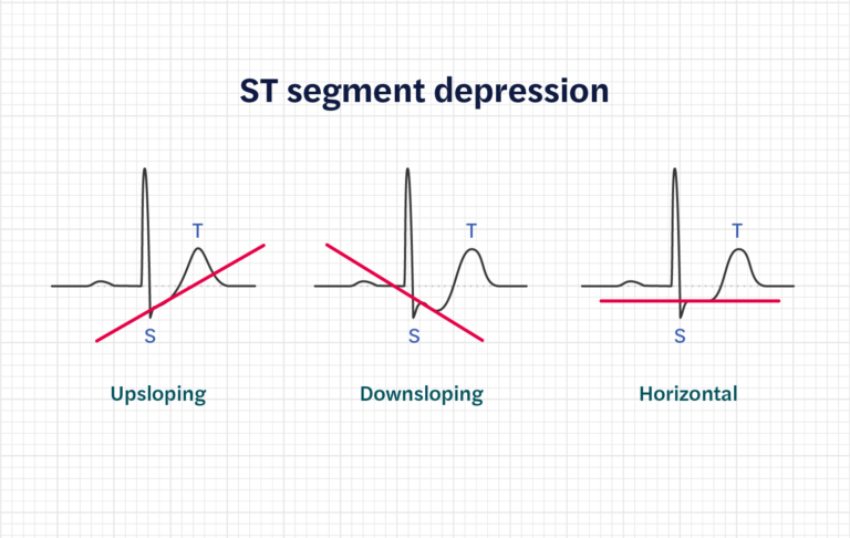 How to calculate heart rate from ECG (or EKG) - Seer Medical