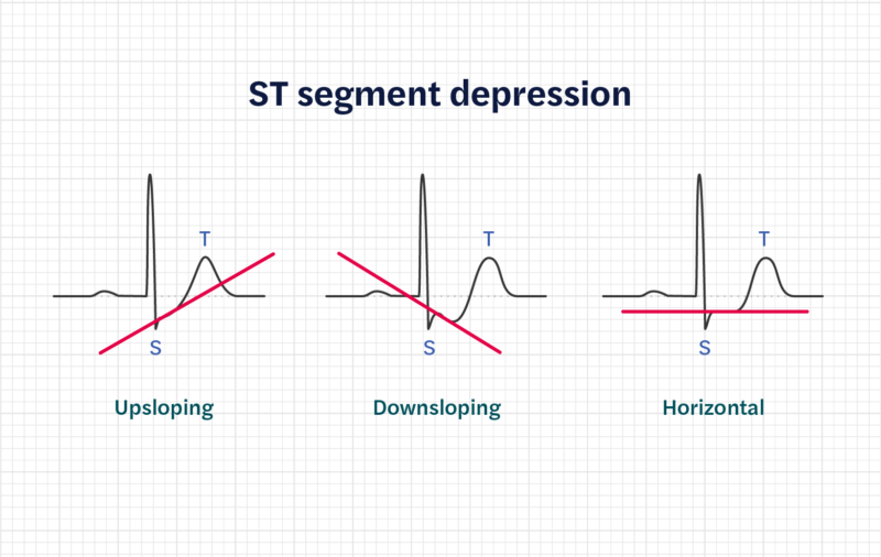 A trace demonstration the different forms of ST segment depression