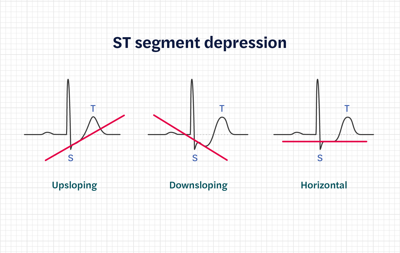 How to calculate heart rate from ECG (or EKG) - Seer Medical